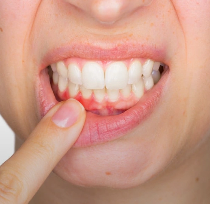 Person pointing to lower gum area with inflamed gingival tissue, demonstrating gum health concern.