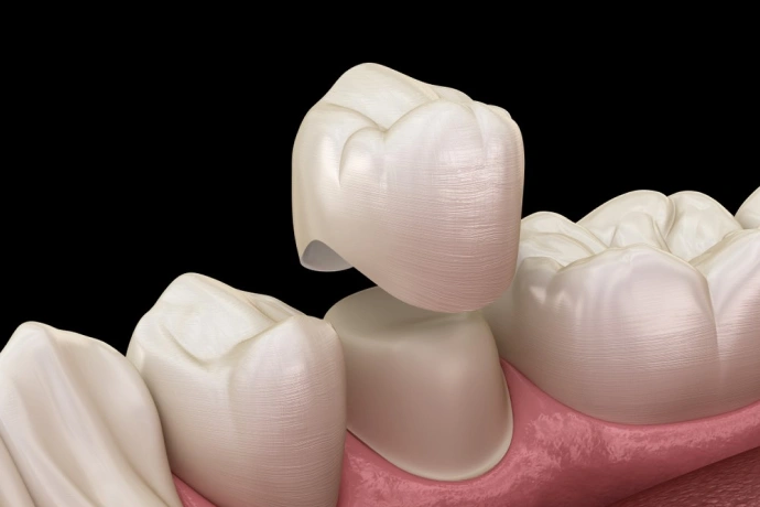 Dental crown being placed on tooth model with pink gum tissue visible against dark background.