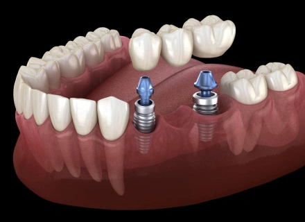 Dental implants shown in jawbone model with abutments and crown components for tooth replacement.