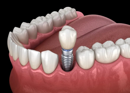 Dental implant illustration showing titanium post anchored in jawbone with crown restoration.