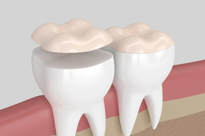 Two white tooth models with crowns on pink gum tissue background, dental restoration illustration.
