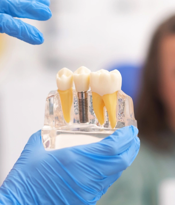 Dental professional in blue gloves holding dental implant model showing tooth restoration options.