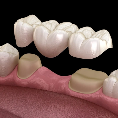 Dental bridge prosthetic shown above gum model with individual crown restorations against black background.