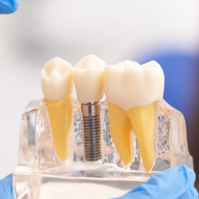 Dental implant model showing natural tooth, implant fixture, and crown restoration on transparent display stand.