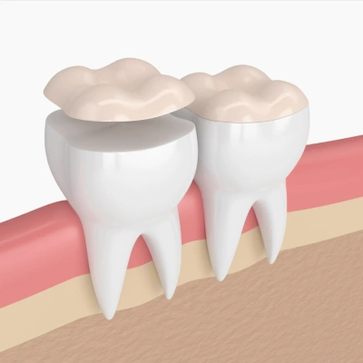 Two white dental crowns with beige caps positioned on tooth roots in gum tissue illustration.