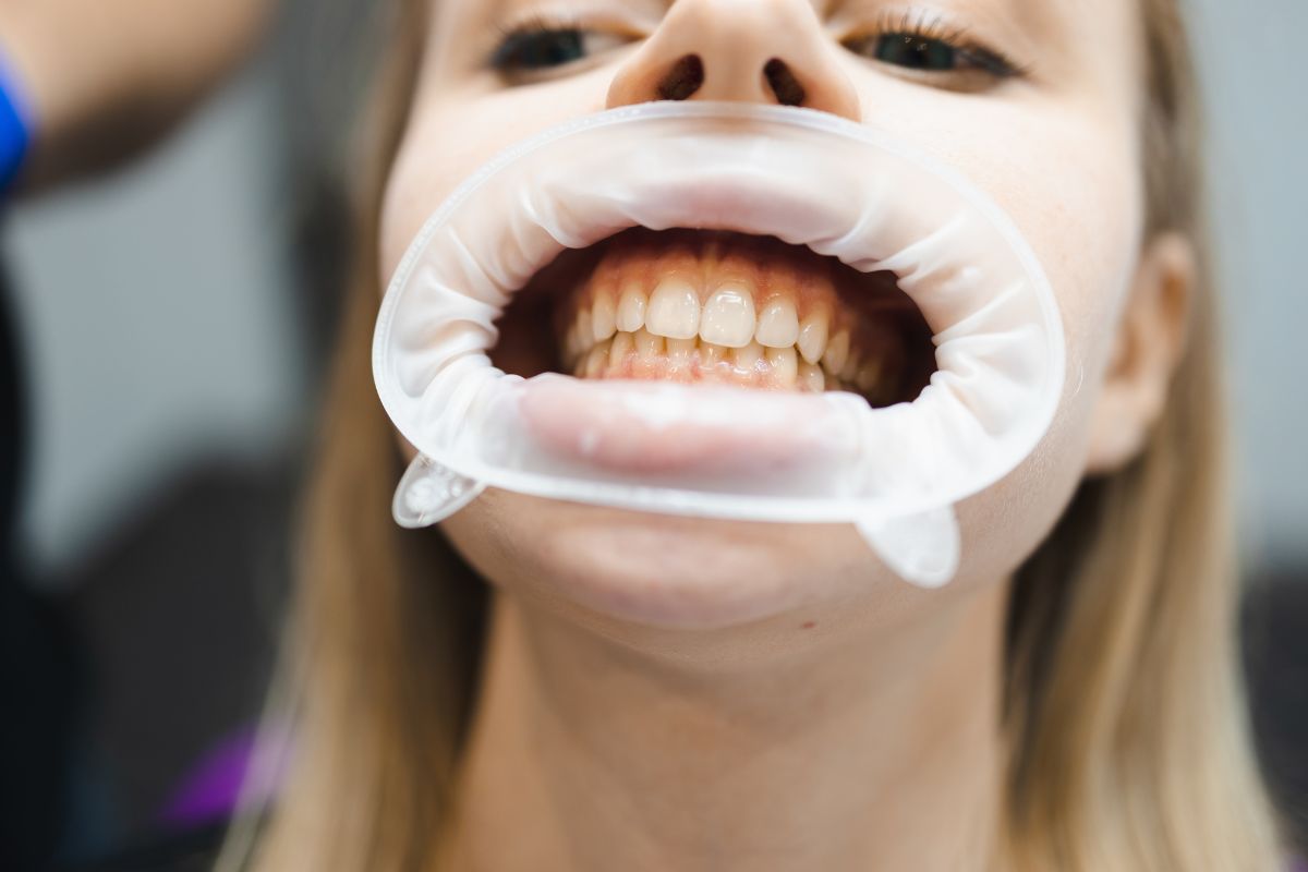 Can Teeth Whitening Damage Teeth