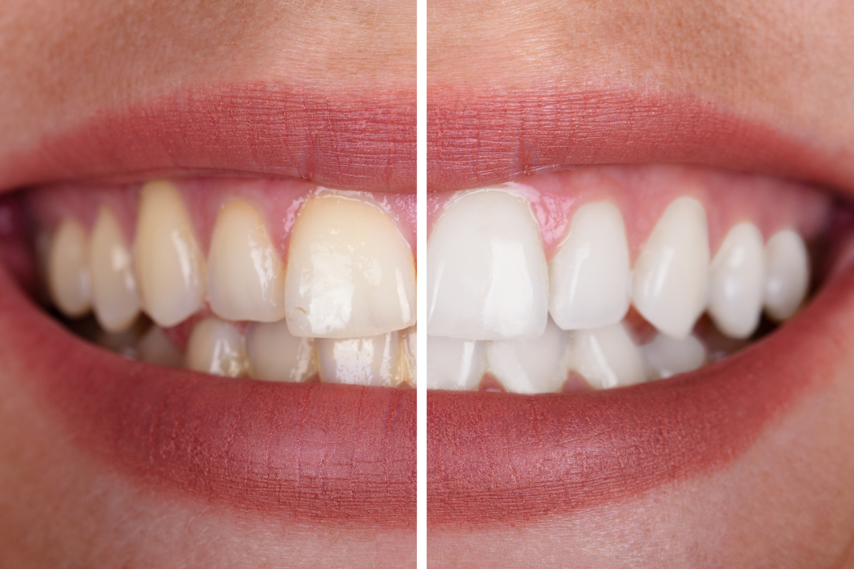 Teeth Whitening in Bartlesville