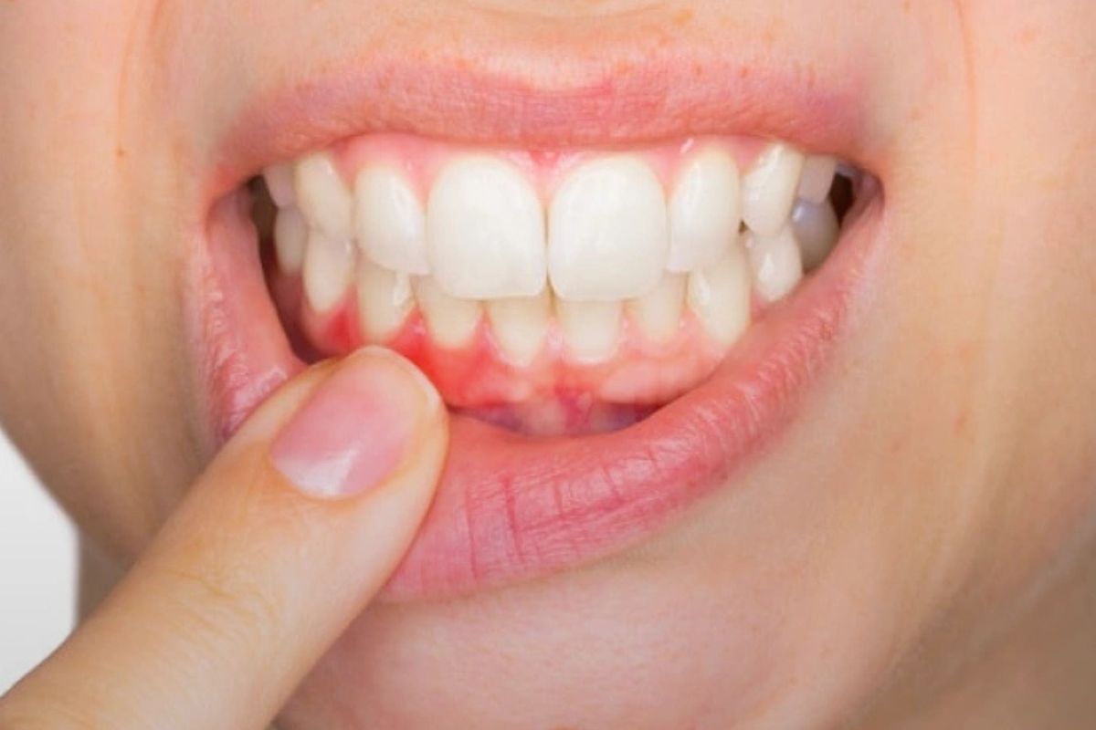 Periodontal disease Bartlesville