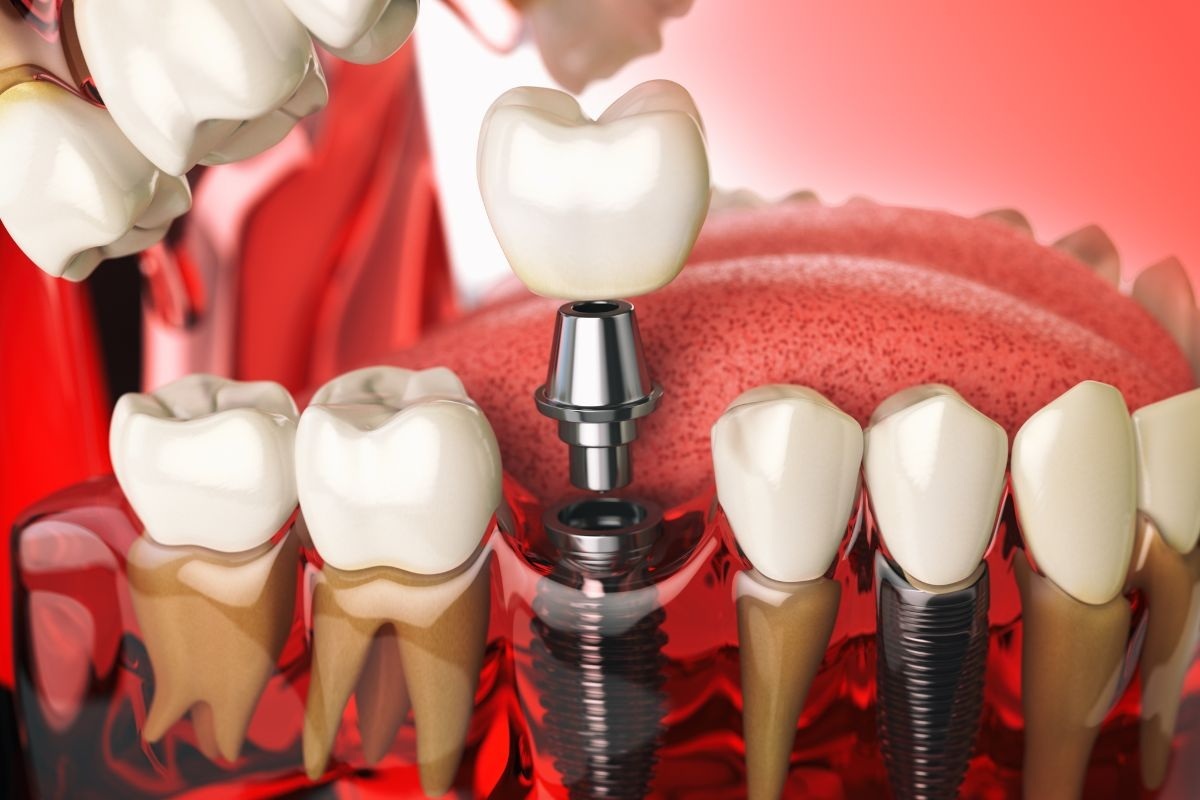 Dental implant illustration showing crown placement on implant post among natural teeth.