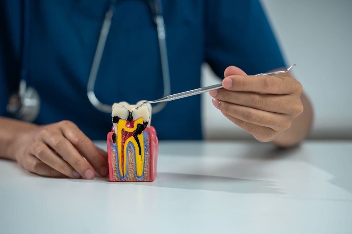Dentist pointing to a tooth decay model with a dental probe to explain root canal treatment.